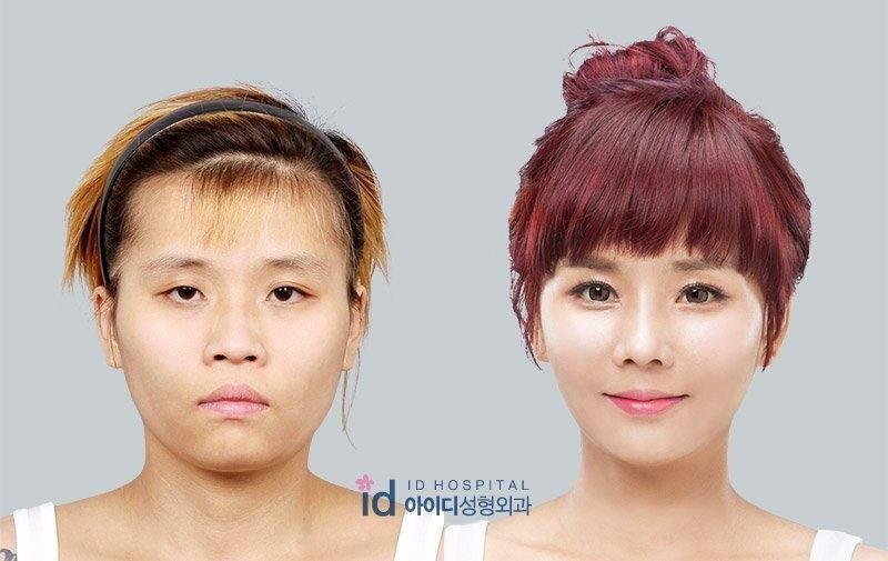 Fotografías facilitadas por el ID Hospital de Seúl, del antes y el después de Bae So-young, la joven de aspecto masculino transformada en &#34;princesa&#34; a golpe de bisturí en un programa de televisión