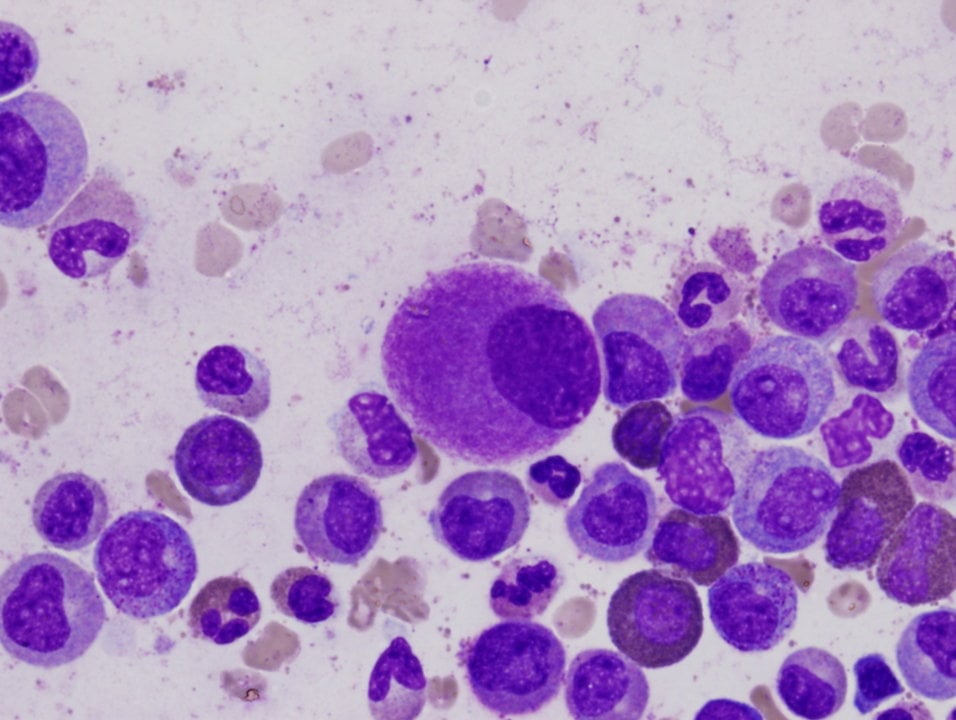 Células cancerígenas en la médula ósea. (FOTO: DIFU WU - WIKIPEDIA).