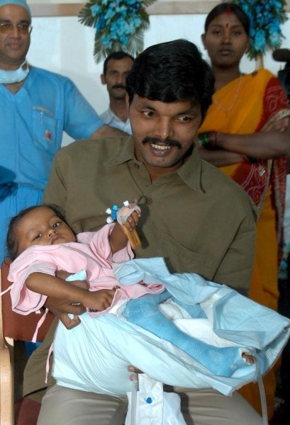 Lakshimi, la niña india que nació con ocho extremidades 