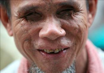 Un indigente ciego sonríe durante una rueda de prensa en la Oficina de Inmigración de Bangkok. (Foto: Rungroj Yougrit)