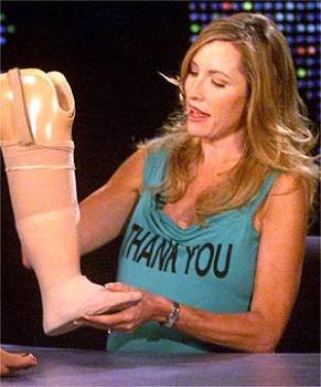 Heather Mills, mostrando su pierna ortopédica. (Foto: ARCHIVO)