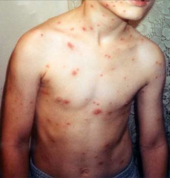 La varicela provoca numerosas ampollas por todo el cuerpo. (Foto: Archivo)