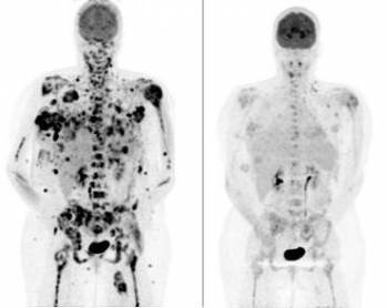 El escaner PET de un paciente de melanoma, muestra una reducción significativa del tamaño y el número de tumores (en negro) 15 días después del tratamiento con un fármaco experimental