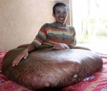 Nguyen Duy Hai y su tumor de 80 kg que ha estado creciendo en su pierna derecha durnte los últimos 30 años. Foto: EFE