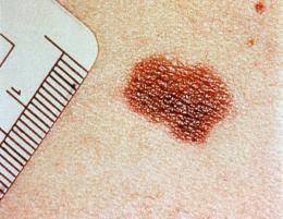 Cuando el diámetro de una mancha en la piel supera los 4-6 milímetros puede tratarse de un melanoma.  (Foto: Archivo EFE)