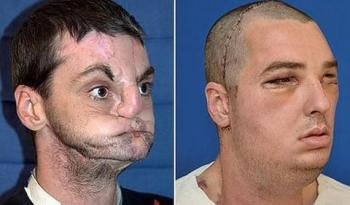 Richard Norris antes y después del transplante de cara