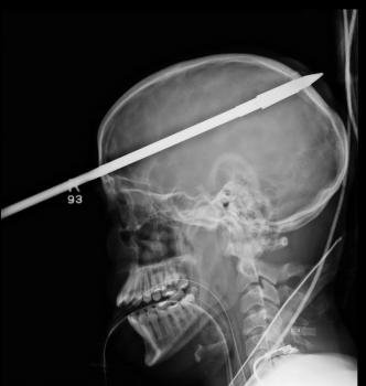 Radiografía de la cabeza del joven Yasser López, de 16 años, con un arpón atravesado. Foto: EFE/Jackson Memorial Hospital Miami