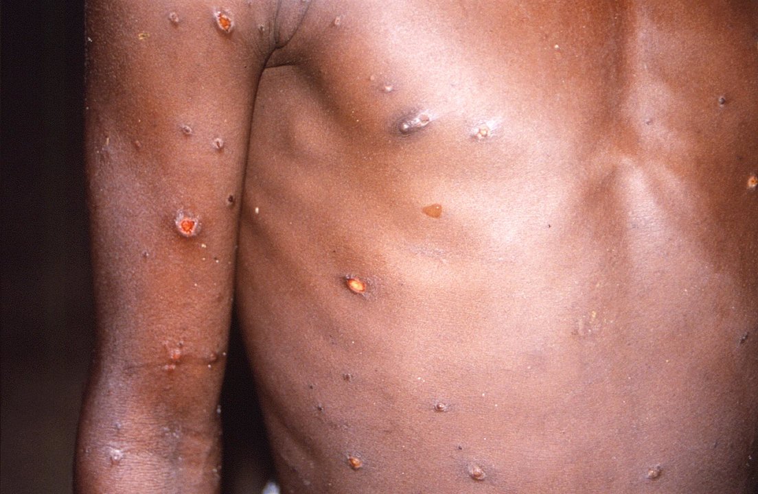 Imagen de las lesiones en la piel provocadas por la viruela del mono (EFE)