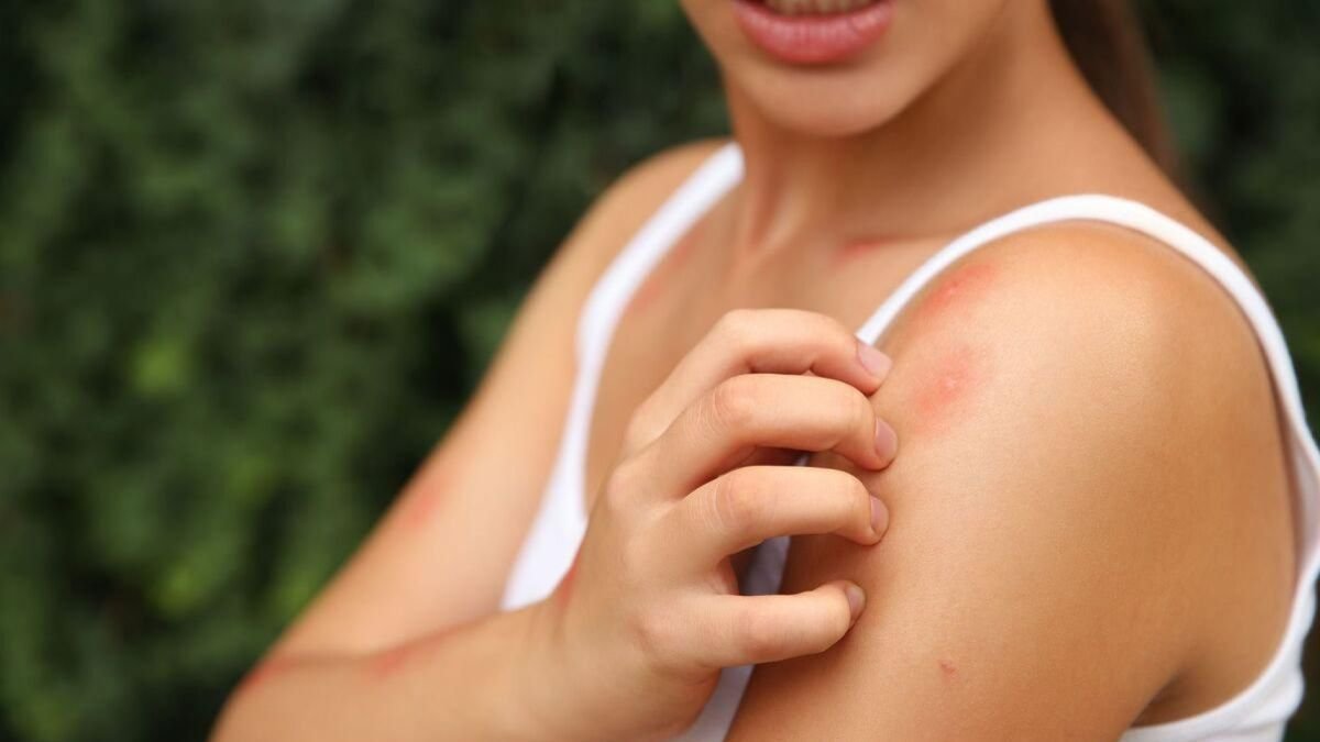 Una mujer con varias picaduras de mosquito.