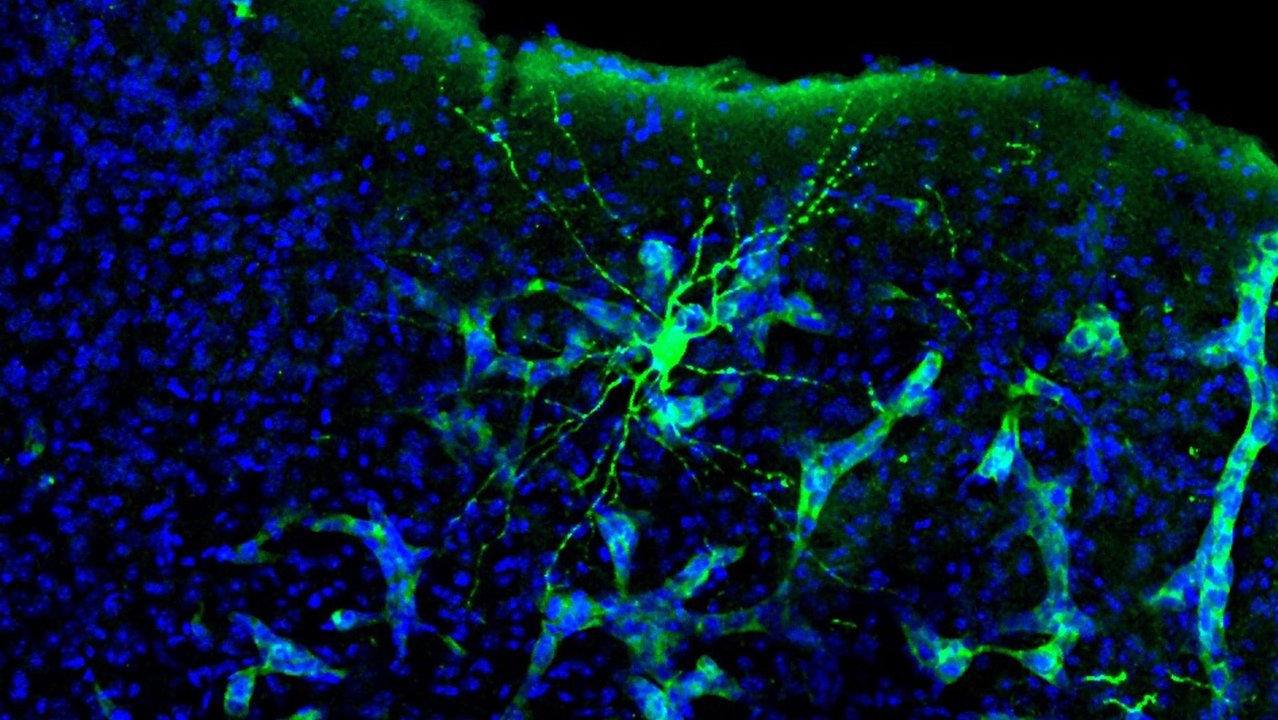 Metástasis en cerebro de ratón. Se aprecia cómo la metástasis (verde más claro) interacciona con una neurona (verde más intenso). Esta neurona está marcada específicamente para su estudio, pero la metástasis está interaccionando con muchas más. (Manuel Valiente/CNIO)