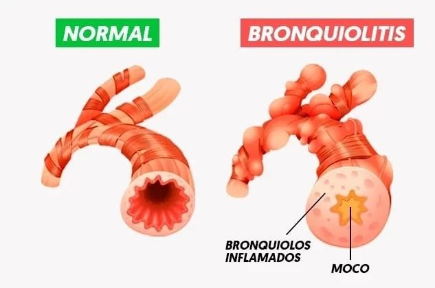 Bronquiolitis. Virus sincitial