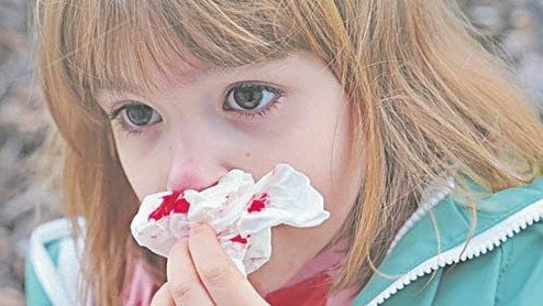 Una niña sangrando por la nariz.